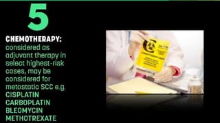 Squamous Cell Carcinoma