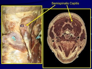 Semispinalis CapitisC2