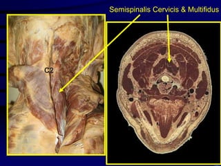 Semispinalis Cervicis & MultifidusC2