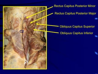 Rectus Capitus Posterior MinorRectus Capitus Posterior MajorObliquus Capitus SuperiorC2Obliquus Capitus Inferior