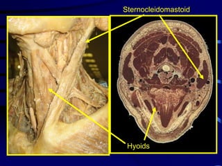 SternocleidomastoidHyoids