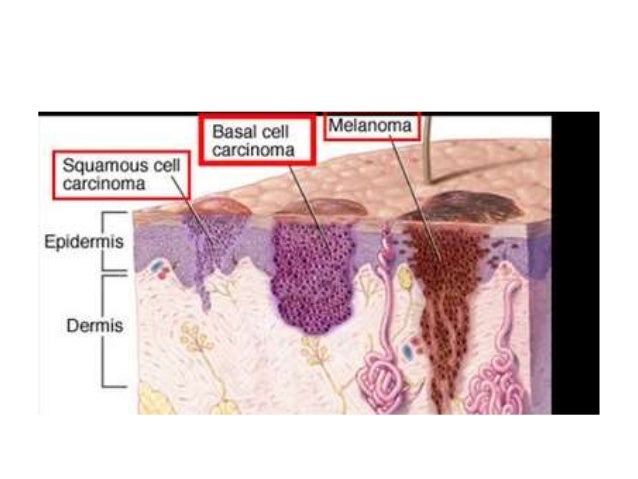 Skin Cancer Picture Image on MedicineNet.com