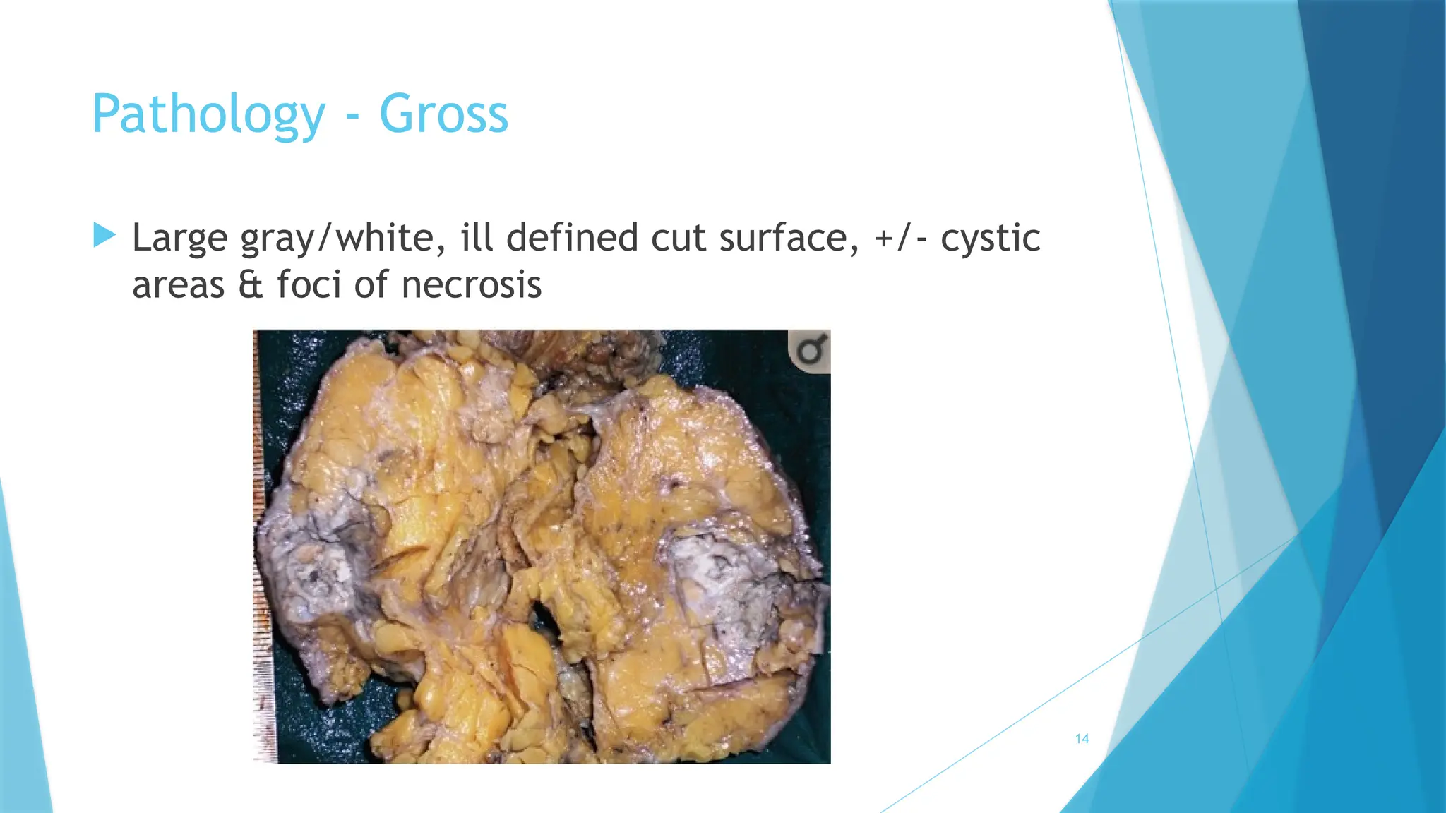 SCC of Breast_CL_Aug 2020.pptx - A diagnostic review | PPT