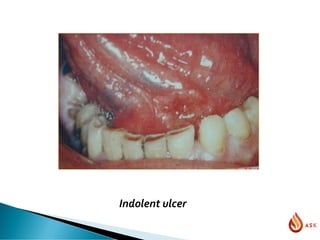 Indolent ulcer
 