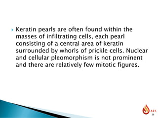  Keratin pearls are often found within the
masses of infiltrating cells, each pearl
consisting of a central area of keratin
surrounded by whorls of prickle cells. Nuclear
and cellular pleomorphism is not prominent
and there are relatively few mitotic figures.
38
 