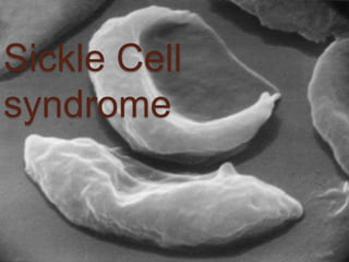Sickle Cell
syndrome
 