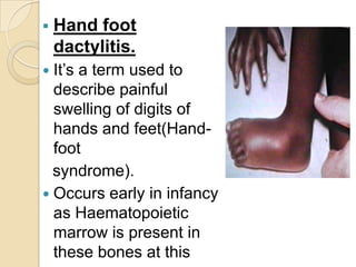 sickle cell syndrome | PPTX