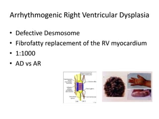 Arrhythmogenic Right Ventricular Dysplasia
• Defective Desmosome
• Fibrofatty replacement of the RV myocardium
• 1:1000
• AD vs AR
 