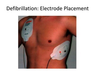 Defibrillation: Electrode Placement
 