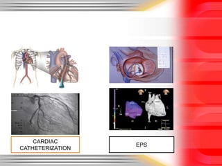 CARDIAC
CATHETERIZATION
EPS
 