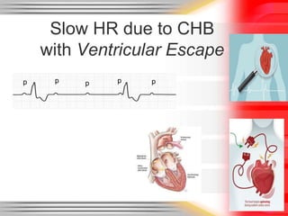 Slow HR due to CHB
with Ventricular Escape
pp p pp
 