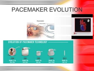 PACEMAKER EVOLUTION
 