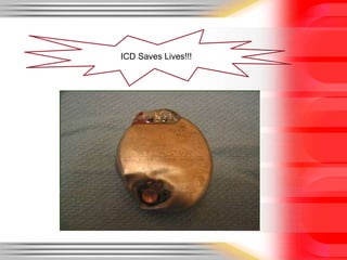 ICD Saves Lives!!!
 