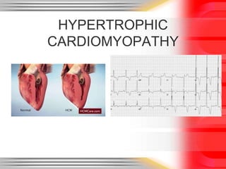 HYPERTROPHIC
CARDIOMYOPATHY
 