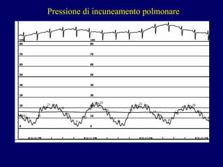 P ressione di incuneamento polmonare 