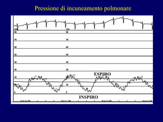 P ressione di incuneamento polmonare ESPIRO INSPIRO 