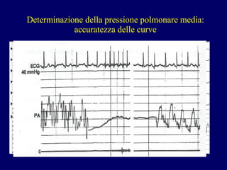 Determinazione della pressione polmonare media: accuratezza delle curve 