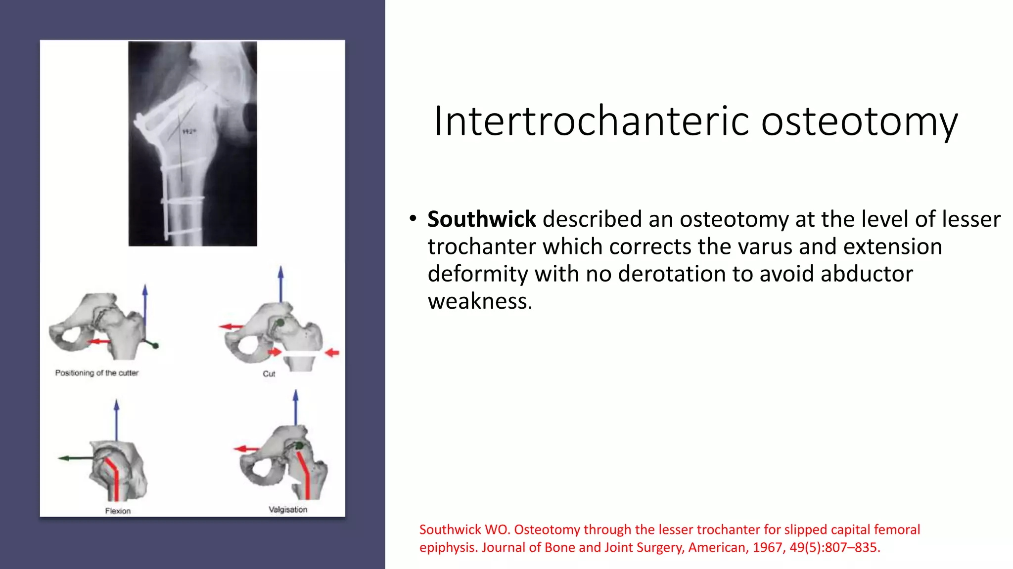 Slipped Capital Femoral Epiphysis | PPTX