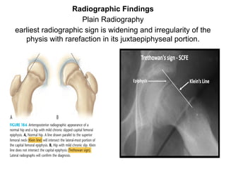 Rarefaction Radiograph Slipped capital femoral epiphysis-Paediatric orthopaedics | PPTX