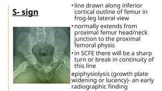 Comprehensive Overview of Slipped Capital Femoral Epiphysis (SCFE) in ...