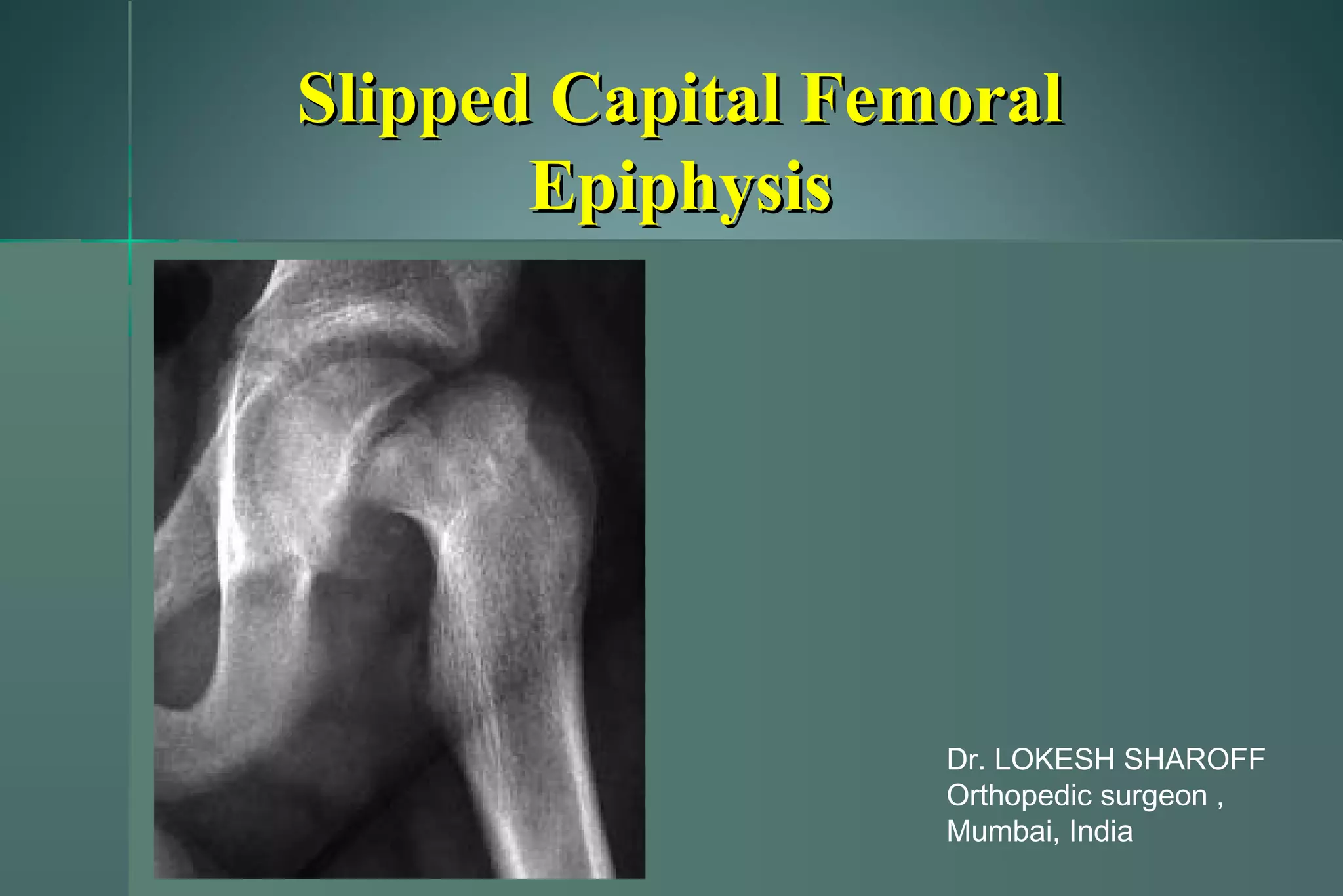 SLIPPED CAPITAL FEMORAL EPIPHYSIS - By Dr. Lokesh Sharoff | PPT