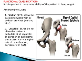Slipped capital femoral epiphysis vamshi kiran feb 6/2013 | PPTX