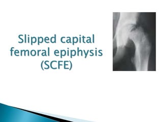Slipped capital
femoral epiphysis
       (SCFE)
 
