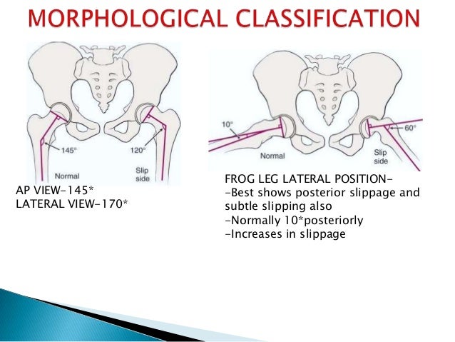 Slipped capital femoral epiphysis vamshi kiran feb 6/2013