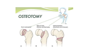 Scfe & osteotomies involved | PPTX