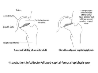http://patient.info/doctor/slipped-capital-femoral-epiphysis-pro
 