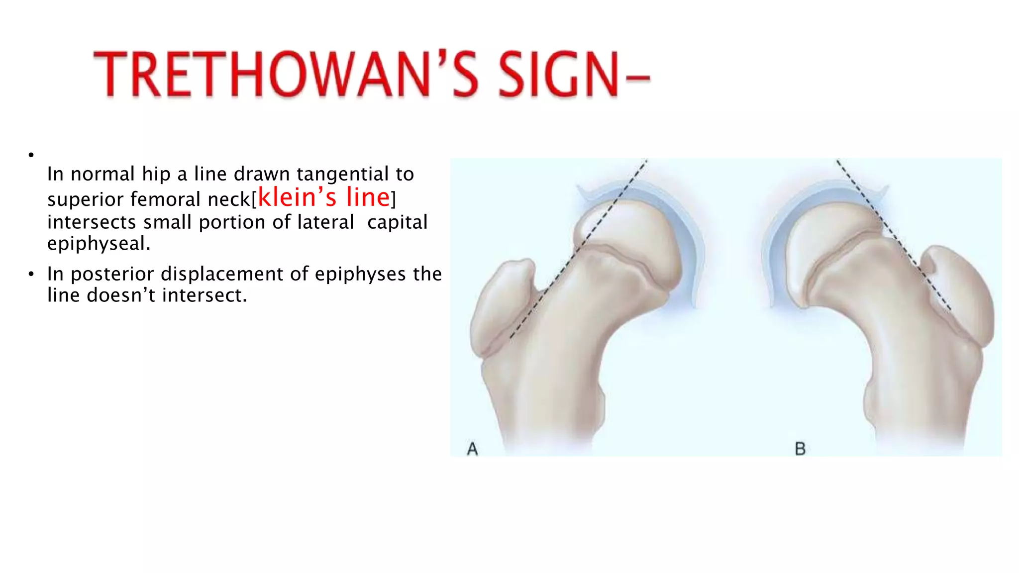 Scfe Line SCFE / slipped capital femoral epiphysis | PPTX