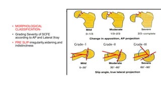 SCFE / slipped capital femoral epiphysis | PPTX