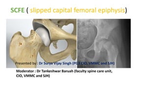 SCFE ( slipped capital femoral epiphysis)
Presented by : Dr Surya Vijay Singh (PG3 CIO, VMMC and SJH)
Moderator : Dr Tankeshwar Baruah (faculty spine care unit,
CIO, VMMC and SJH)
 