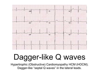 Dagger-like Q waves
Hypertrophic (Obstructive) Cardiomyopathy HCM (HOCM);
Dagger-like “septal Q waves” in the lateral leads.
 