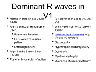 Dominant R waves in
V1• Normal in children and young
adults
• Right Ventricular Hypertrophy
(RVH)
• Pulmonary Embolus
• Persistence of infantile
pattern
• Left to right shunt
• Right Bundle Branch Block
(RBBB)
• Posterior Myocardial Infarction
(ST elevation in Leads V7, V8,
V9)
• Wolff-Parkinson-White (WPW)
Type A
• Incorrect lead placement (e.g.
V1 and V3 reversed)
• Dextrocardia
• Hypertrophic cardiomyopathy
• Dystrophy
• Myotonic dystrophy
• Duchenne Muscular dystrophy
 