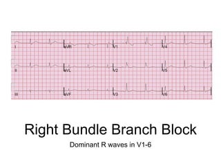 Right Bundle Branch Block
Dominant R waves in V1-6
 