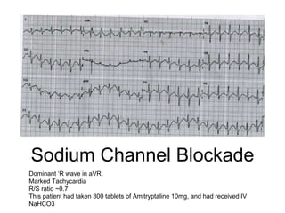 Sodium Channel Blockade
Dominant ‘R wave in aVR.
Marked Tachycardia
R/S ratio ~0.7
This patient had taken 300 tablets of Amitryptaline 10mg, and had received IV
NaHCO3
 