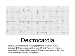 Dextrocardia
Positive QRS complexes (with upright P and T waves) in aVR.
Negative QRS complexes (with inverted P and T waves) in lead I.
Marked right axis deviation. Absent R-wave progression in the chest
leads (dominant S waves throughout)
 