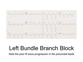 Left Bundle Branch Block
Note the poor R wave progression in the precordial leads
 
