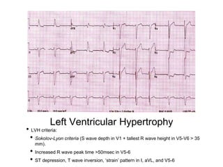 Left Ventricular Hypertrophy
• LVH criteria:
• Sokolov-Lyon criteria (S wave depth in V1 + tallest R wave height in V5-V6 > 35
mm).
• Increased R wave peak time >50msec in V5-6
• ST depression, T wave inversion, ‘strain’ pattern in I, aVL, and V5-6
 