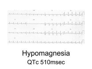 Hypomagnesia
QTc 510msec
 