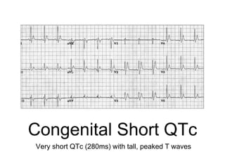 Congenital Short QTc
Very short QTc (280ms) with tall, peaked T waves
 