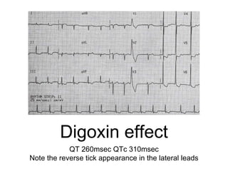 Digoxin effect
QT 260msec QTc 310msec
Note the reverse tick appearance in the lateral leads
 