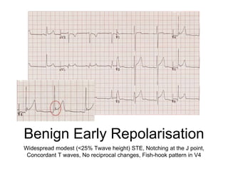 Benign Early Repolarisation
Widespread modest (<25% Twave height) STE, Notching at the J point,
Concordant T waves, No reciprocal changes, Fish-hook pattern in V4
 