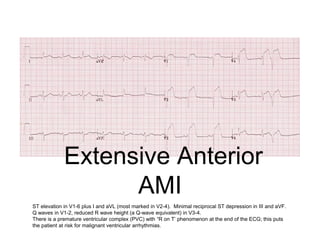 Extensive Anterior
AMI
ST elevation in V1-6 plus I and aVL (most marked in V2-4). Minimal reciprocal ST depression in III and aVF.
Q waves in V1-2, reduced R wave height (a Q-wave equivalent) in V3-4.
There is a premature ventricular complex (PVC) with “R on T’ phenomenon at the end of the ECG; this puts
the patient at risk for malignant ventricular arrhythmias.
 