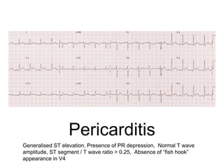 Pericarditis
Generalised ST elevation, Presence of PR depression, Normal T wave
amplitude, ST segment / T wave ratio > 0.25, Absence of “fish hook”
appearance in V4
 