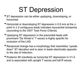 ST Depression
•ST depression can be either upsloping, downsloping, or
horizontal.
•Horizontal or downsloping ST depression ≥ 0.5 mm at the J-
point in ≥ 2 contiguous leads indicates myocardial ischaemia
(according to the 2007 Task Force Criteria).
•Upsloping ST depression in the precordial leads with
prominent “De Winter’s” T waves is highly specific for
occlusion of the LAD.
•Reciprocal change has a morphology that resembles “upside
down” ST elevation and is seen in leads electrically opposite
to the site of infarction.
•Posterior MI manifests as horizontal ST depression in V1-3
and is associated with upright T waves and tall R waves.
 