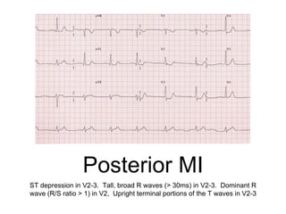 Posterior MI
ST depression in V2-3. Tall, broad R waves (> 30ms) in V2-3. Dominant R
wave (R/S ratio > 1) in V2, Upright terminal portions of the T waves in V2-3
 