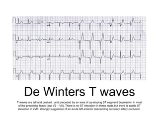 De Winters T waves
T waves are tall and peaked , and preceded by an area of up-sloping ST segment depression in most
of the precordial leads (esp V2 – V5). There is no ST elevation in these leads but there is subtle ST
elevation in aVR. strongly suggestive of an acute left anterior descending coronary artery occlusion.
 