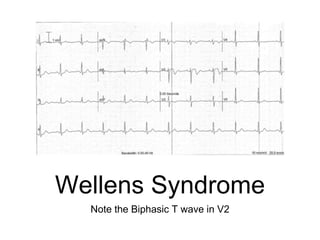 Wellens Syndrome
Note the Biphasic T wave in V2
 